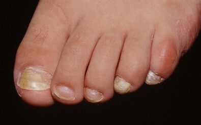 The causes of the fungus of the thumb