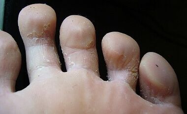 What does the fungus look like and how to treat it