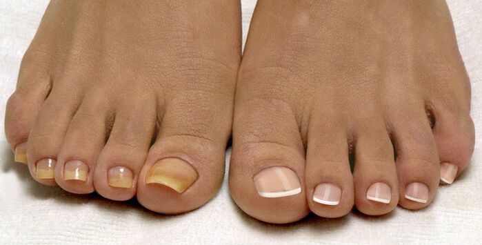 Fungus on the nails of one foot