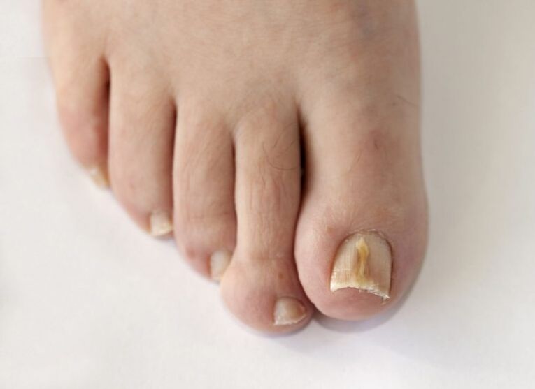 The nail plate of the feet is affected by fungus