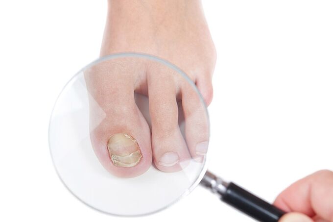 A nail affected by fungus under a magnifying glass